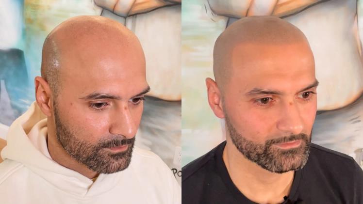 Crafting Confidence Empowering Scalp Micropigmentation Artists through Londons Training Courses